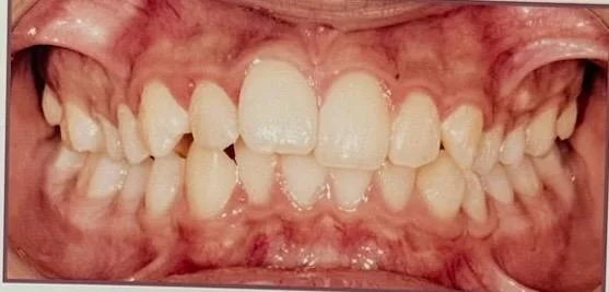 Before orthodontic consult image for misaligned teeth case in Dubai