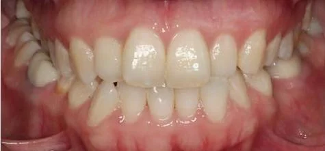 Before image for orthodontic treatment consult involving bite and alignment concerns